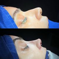rinoplastika_1200_azn