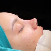 rinoplastika_lor.cerrah