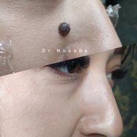 xal_papilloma