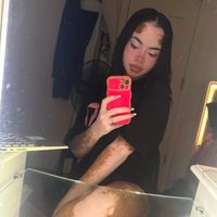 vitiligoprincess2010