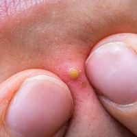 sticky_pimples