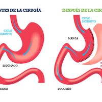 miprocesobariatric