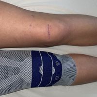 janina.knee.recover